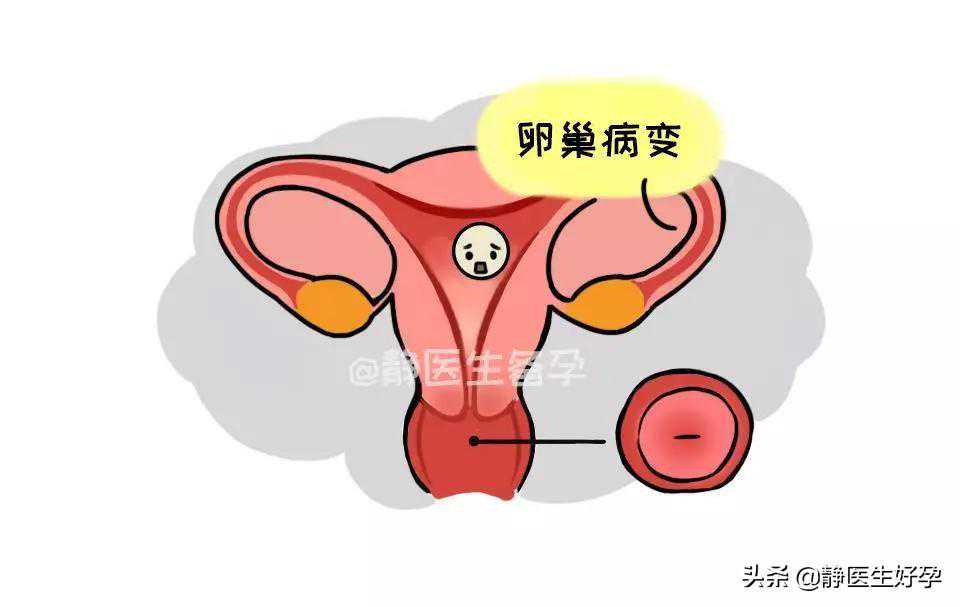 (a)代孕费用包生,备孕遇上排卵障碍，3个小妙招有效促排卵